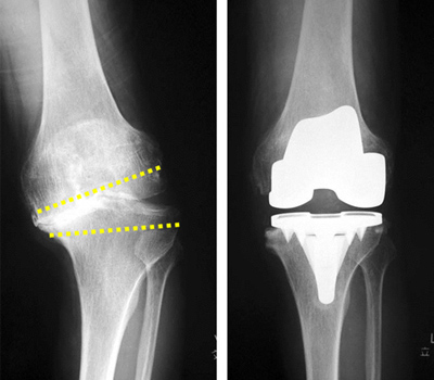 人工膝関節置換術（TKA）