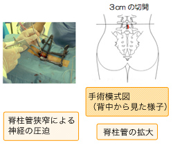 手術模式図（背中から見た様子） 